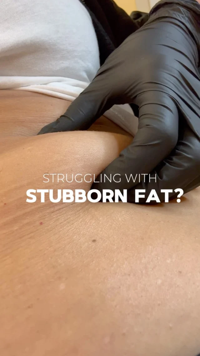 Stubborn fat that resists diet and workouts? 

Crioliposculpt is the non-invasive treatment that targets localized fat through controlled cooling—reducing up to 30% of fat cells in the treated area.

No needles, no downtime, no pain. Just visible, long-lasting results in a few weeks. 
Perfect for sculpting areas like the abdomen, thighs, flanks, and arms.

Ready to redefine your silhouette?

Clinica Milano Skin Lab is a prestigious aesthetic medicine center located in the heart of Milan, just steps from San Babila. Known for its excellence and discretion, the clinic offers a personalized and refined experience for each patient. Our highly qualified medical staff speaks fluent English, making it the ideal destination for international clients seeking quality and comfort.

Write CRYO in the comments to receive all the info or contact us directly: 

Clinica Milano Skin Lab 
Via Cerva 22, Milano 
info@clinicamilano.it – 351 5508190

#cryo #cryoliposculpt #fatreduction #estheticmedicine #milanfatreduction #milanestheticlinic #estheticcenter #aesthetic #aestethicmilan #aesthetic
